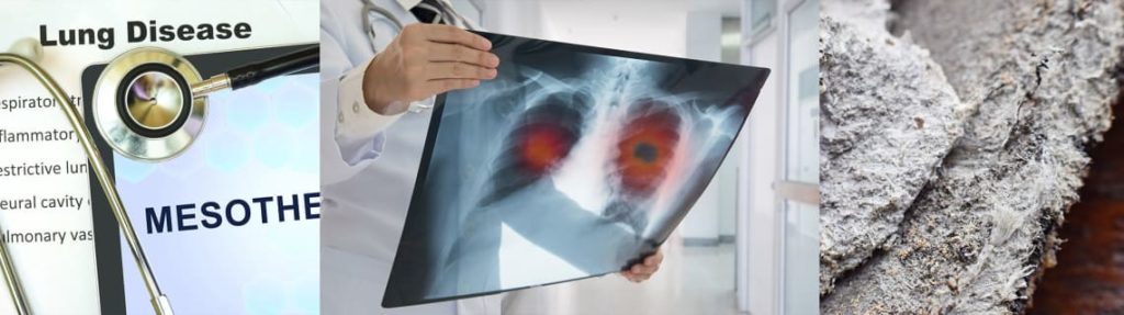 Composite graphic featuring images related to lung cancer or mesothelioma