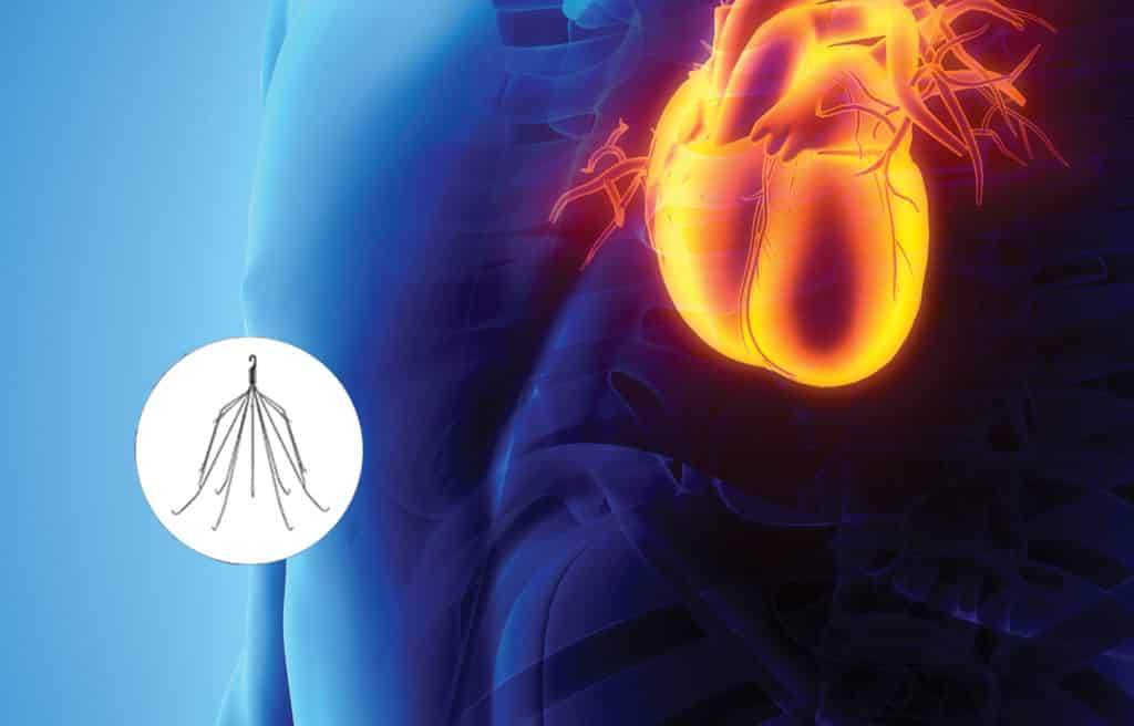 Graphic to represent the effects of IVC filter inside the body